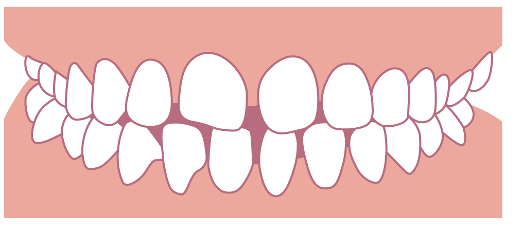 空隙歯列