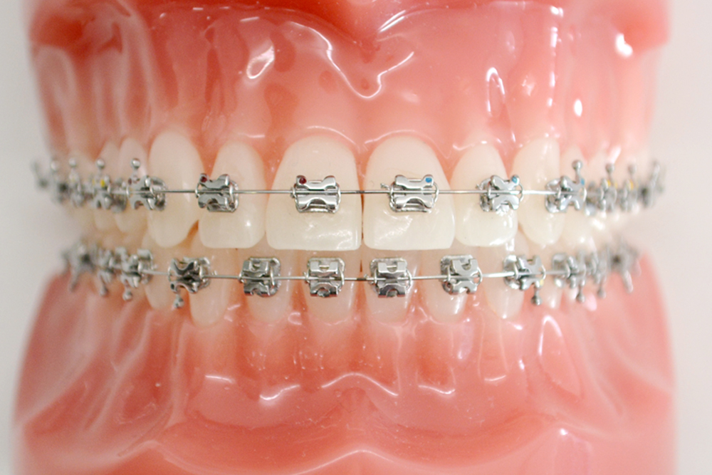 矯正装置の種類 |松江 りゅう矯正歯科クリニック