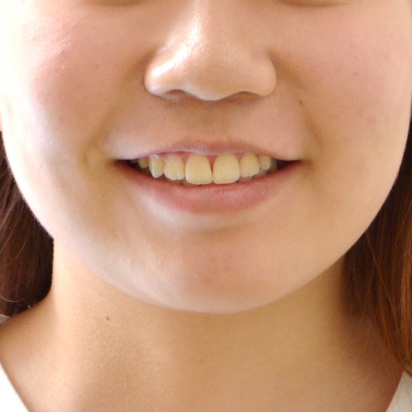 上顎前突 出っ歯 治療例 松江 りゅう矯正歯科クリニック