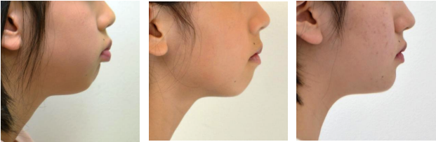 治療前と治療後